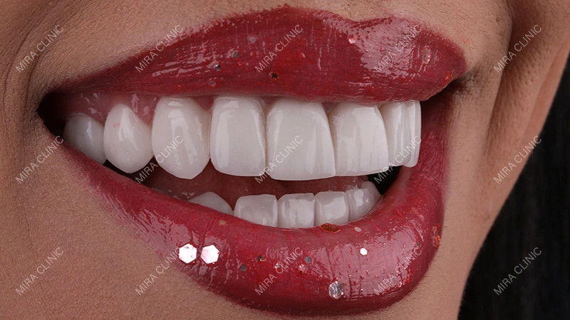 Hollywood Smile treatments